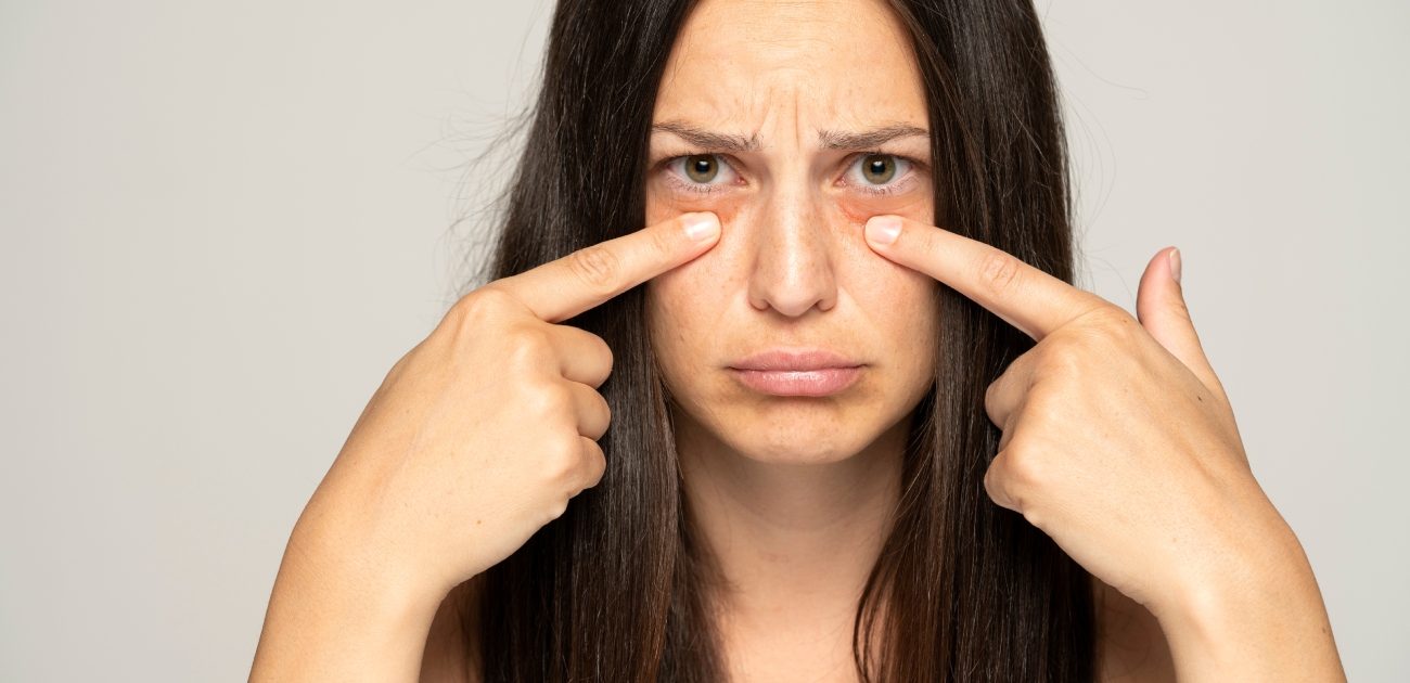 تعلمي كيفية علاج الهالات السوداء بأسرع وقت ممكن
