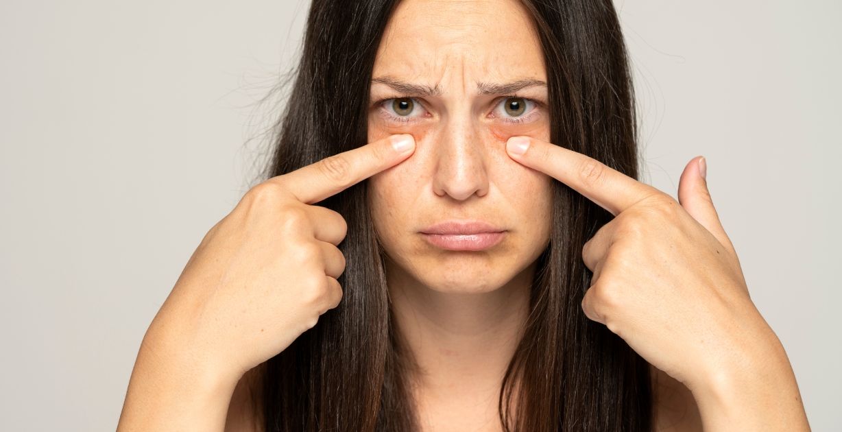 كيفية إزالة الهالات السوداء تحت العين بأسرع وقت