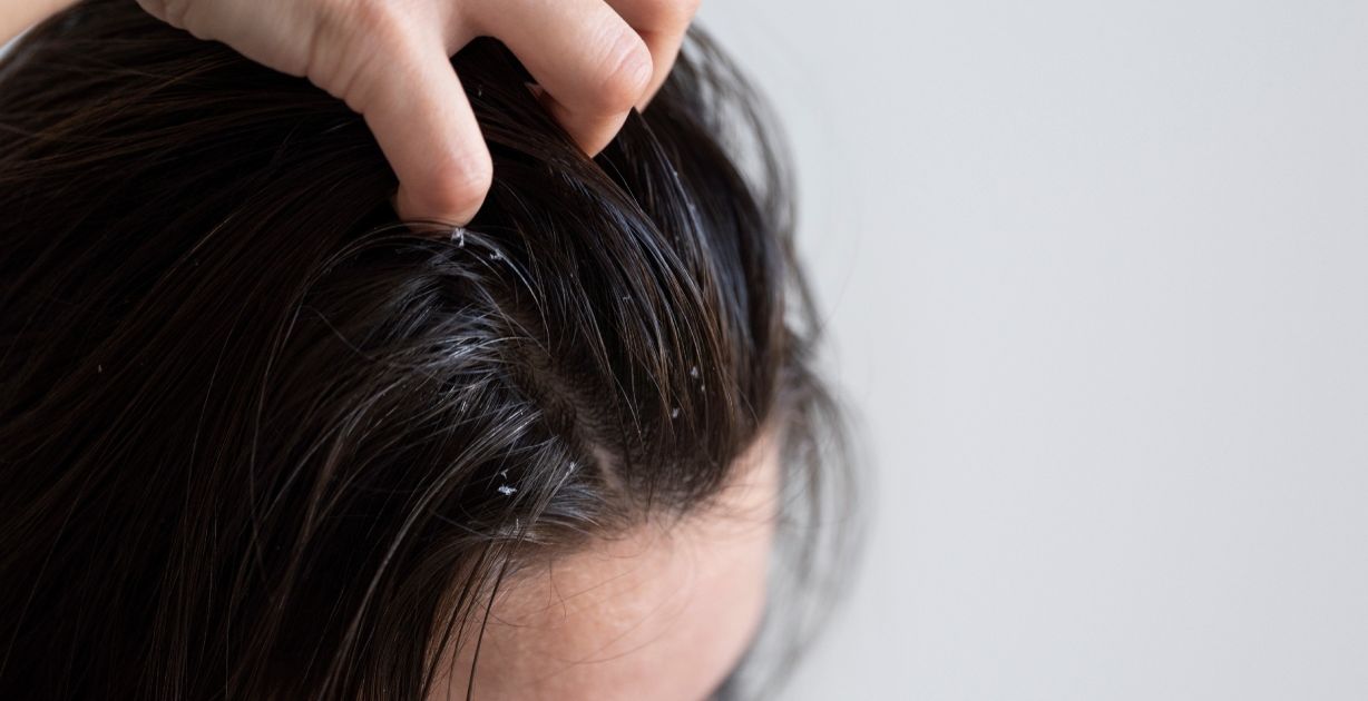 أسباب قشرة الشعر في الشتاء وطرق فعالة للتخلص منها