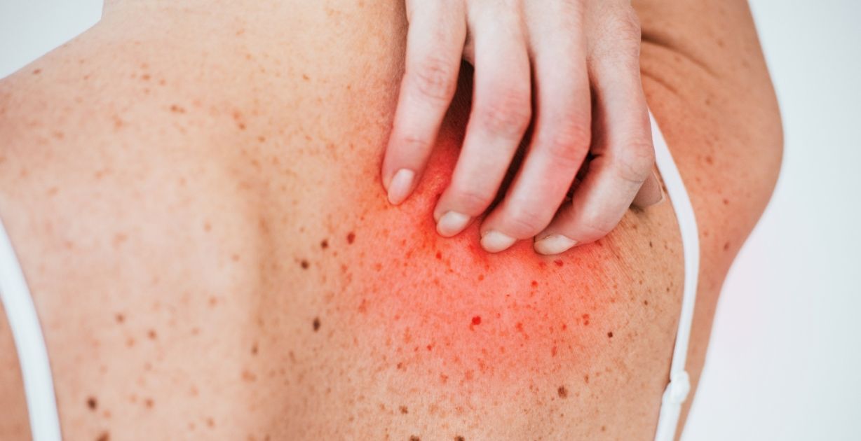 ظهور حبوب في الظهر فجأة مع حكة هل من علاج حقيقي لها؟