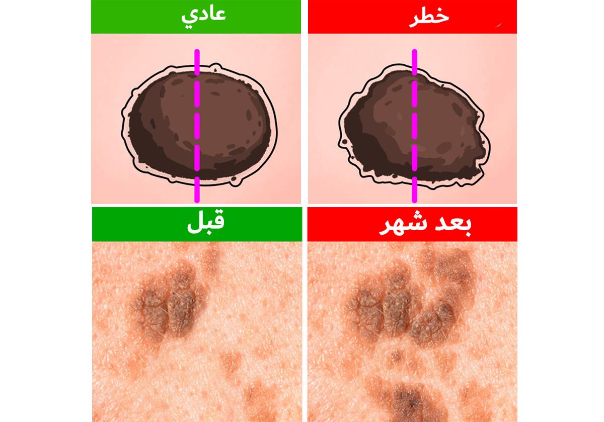 5 علامات أنّ الشامة على جسدك خطرة وعليك فحصها