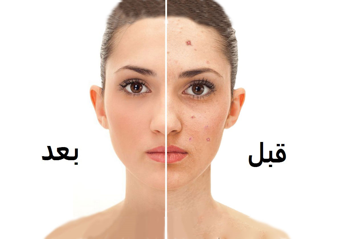 مشروب سحري بمكونين يقضي على الحبوب خلال يومين فقط!
