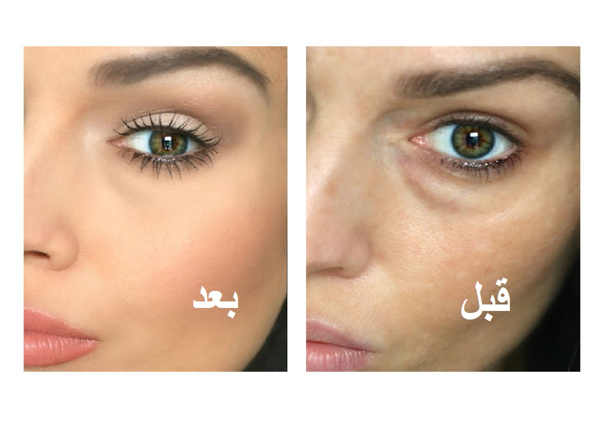 بخطوتين بسيطتين تخلصي من ظهور انتفاخ عينيك!