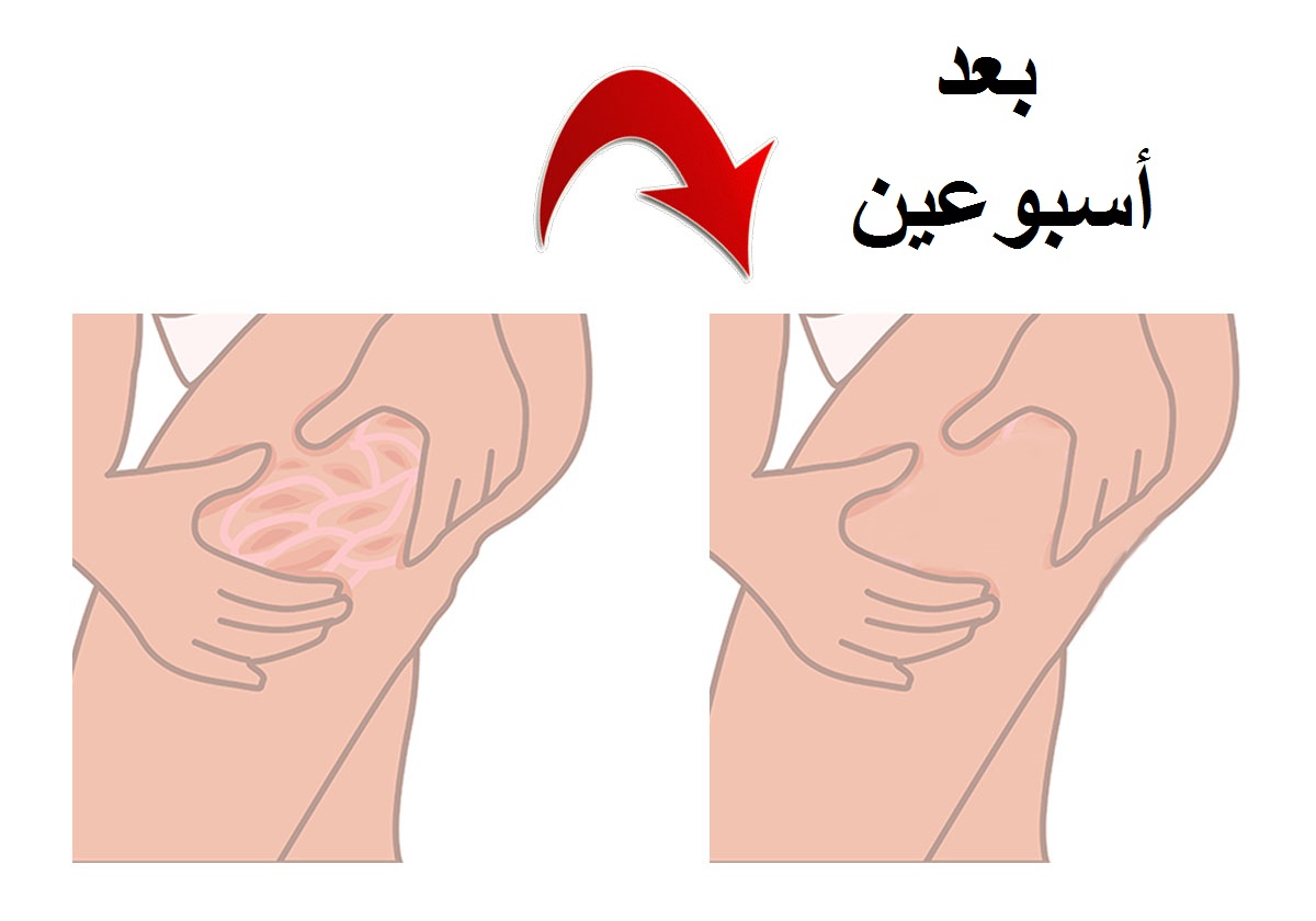 طبقي هذه التمارين ل 10 دقائق في الصباح وودعي السيلوليت نهائياً!