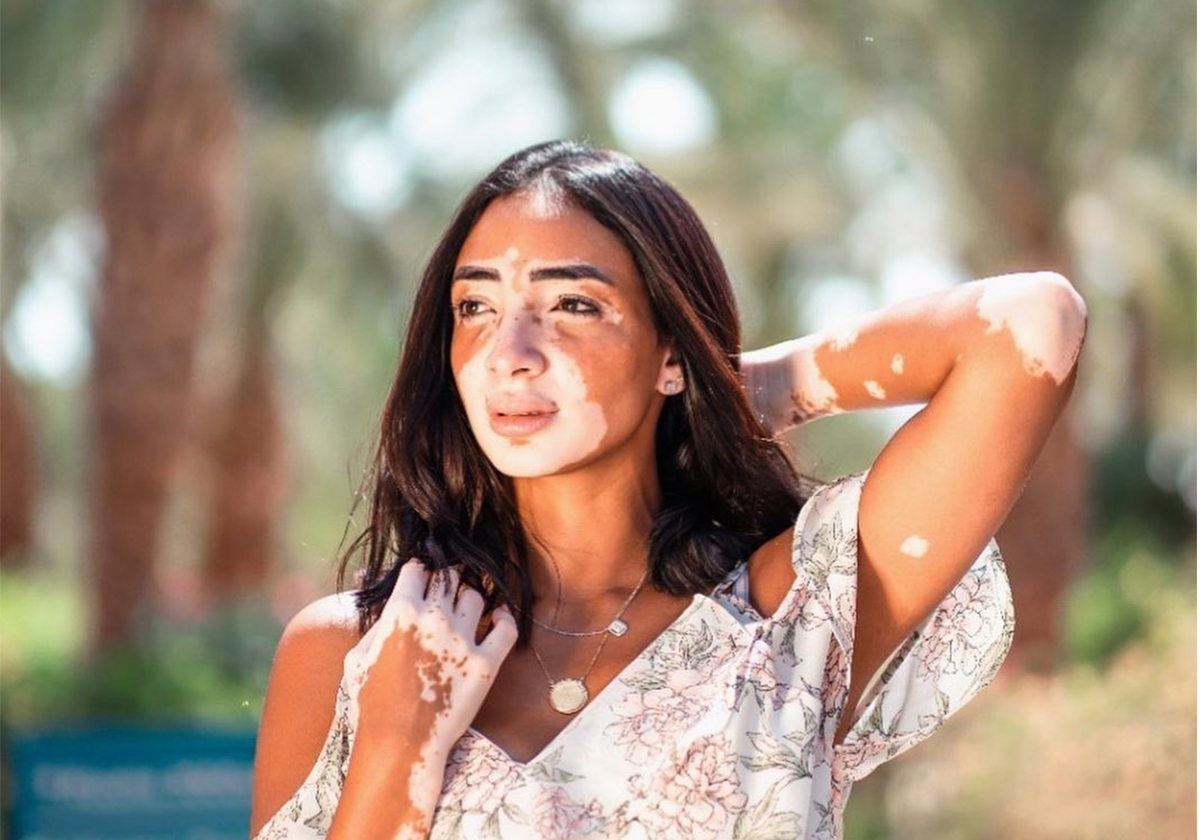 نجمات عربيات اصيبوا بالبهاق ولم يؤثر ذلك على نجاحاتهن