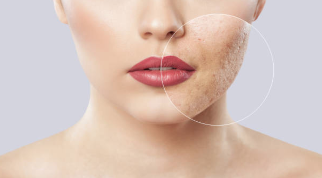 أطعمة تحارب بثور الوجه والجسم