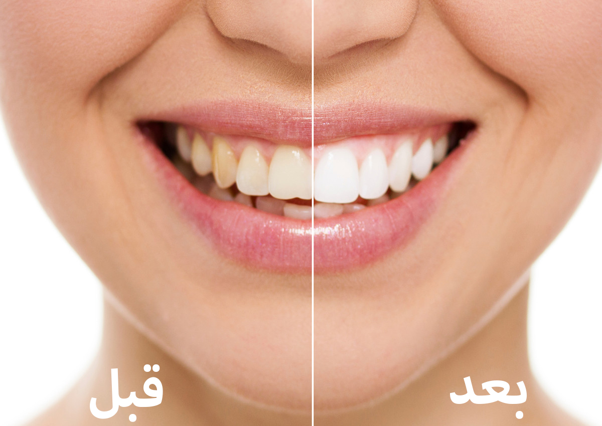 مكوّن طبيعي يبيّض أسنانك في يوم واحد