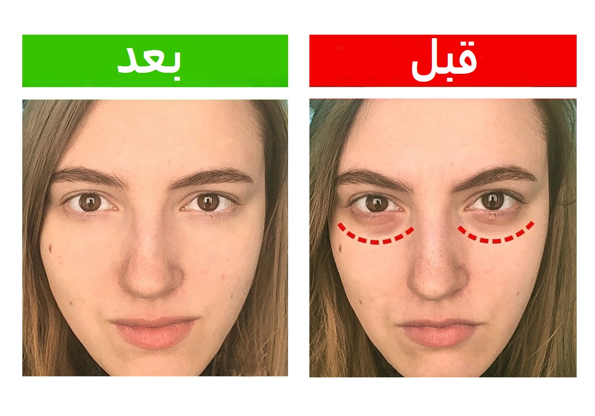 ما هي الطريقة الأفضل للتخلص من الهالات السوداء بحسب لونها ونوعها!