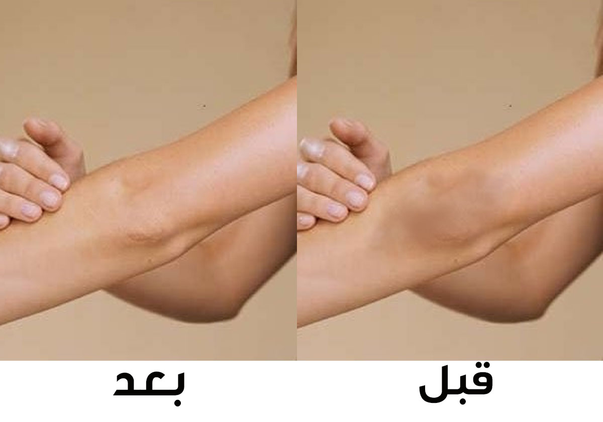 خلطة الخل المذهلة لتبييض الكوعين والركبتين  خلال 20 دقيقة!