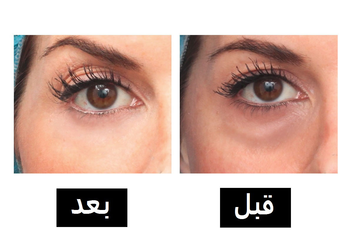 اضغطي على هذه المنطقة من وجهك وتخلصي من الانتفاخ والهالات السوداء في 30 ثانية!