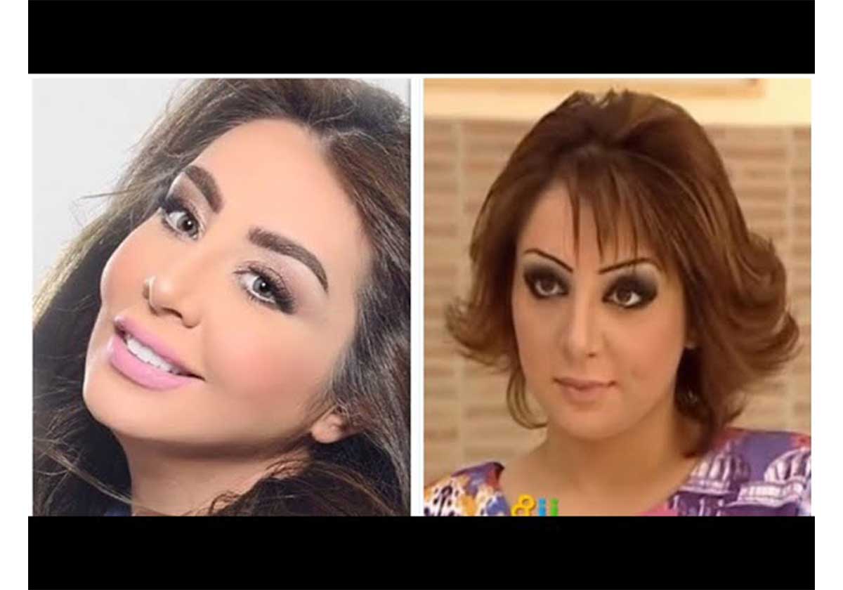 شيماء علي قبل وبعد التجميل