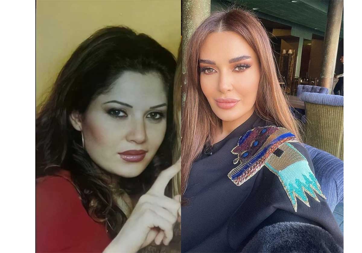 سيرين عبد النور قبل وبعد التجميل