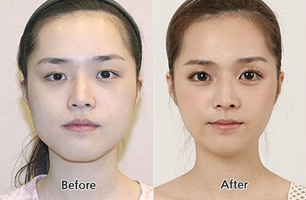 عمليات التجميل الغريبة تجتاح كوريا!