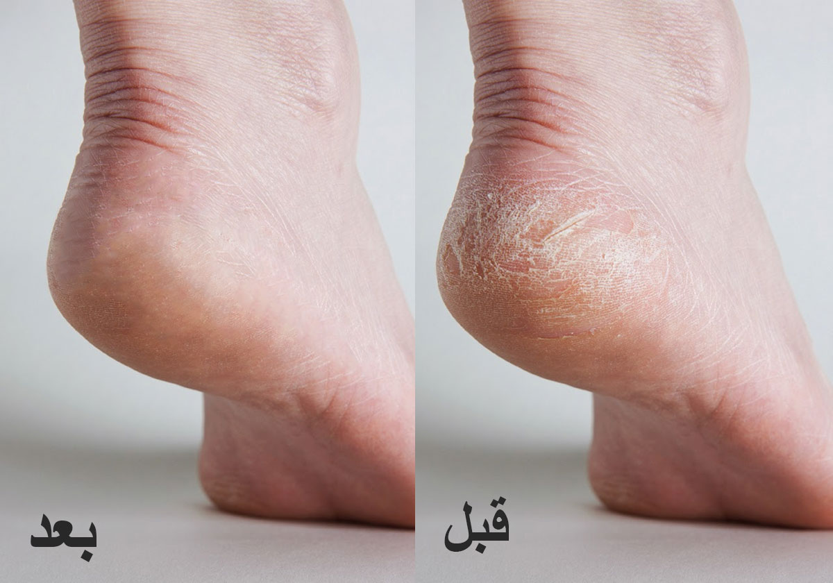 قشر الليمون يخلصك من تشققات كعب القدم خلال نصف ساعة... والطريقة بسيطة!