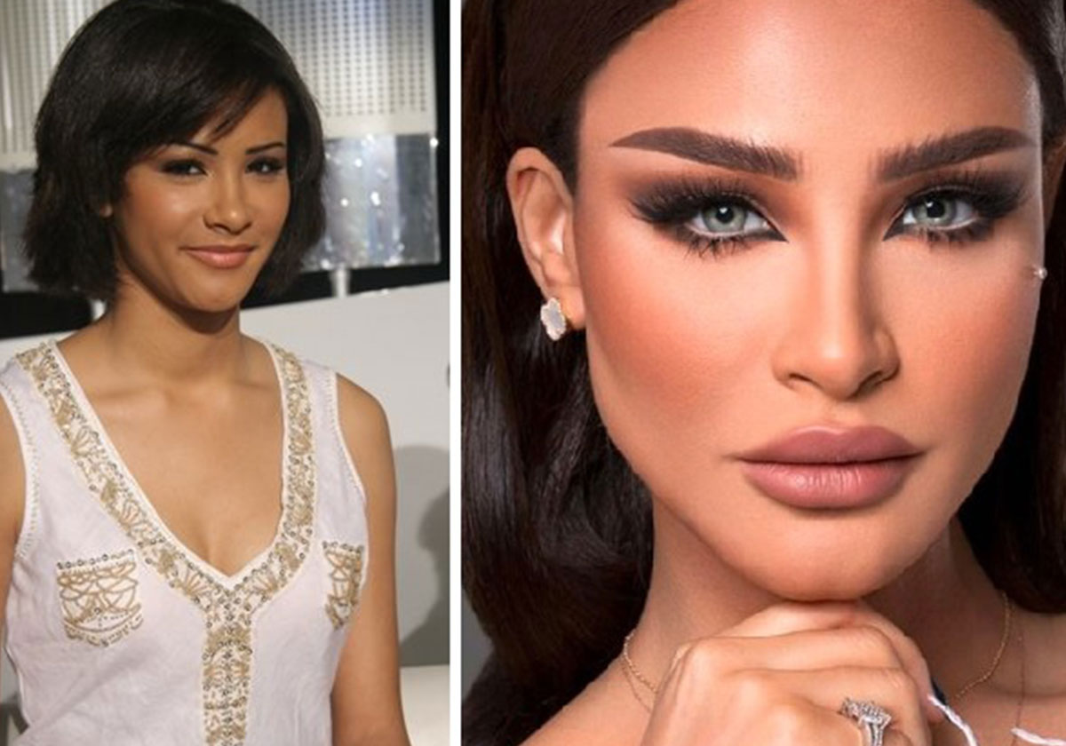 اميمة طالب قبل وبعد عمليات التجميل