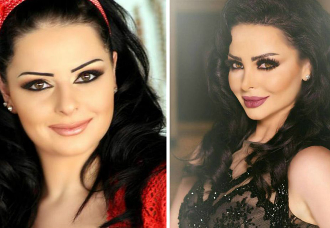 ديانا كرزون قبل تكبير الشفاه