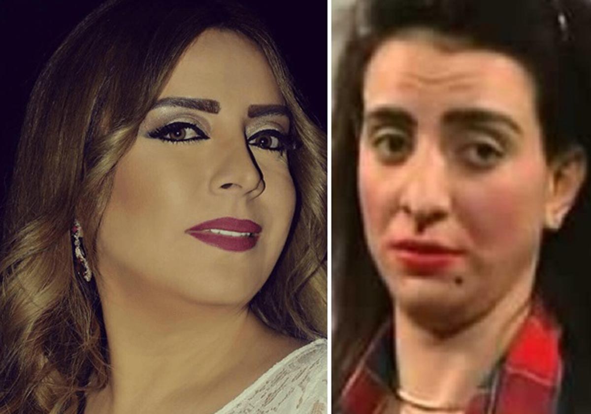 شكران مرتجى قبل التجميل وبعده