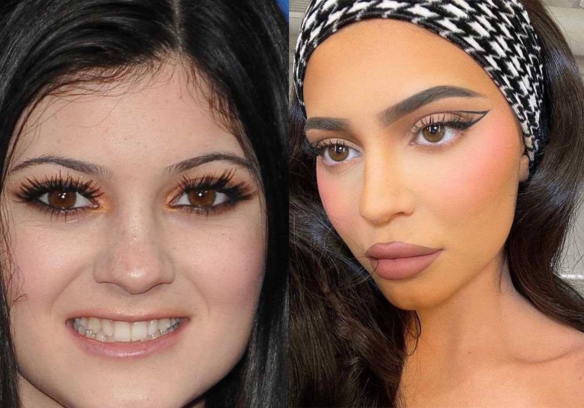كايلي جينر قبل وبعد التجميل