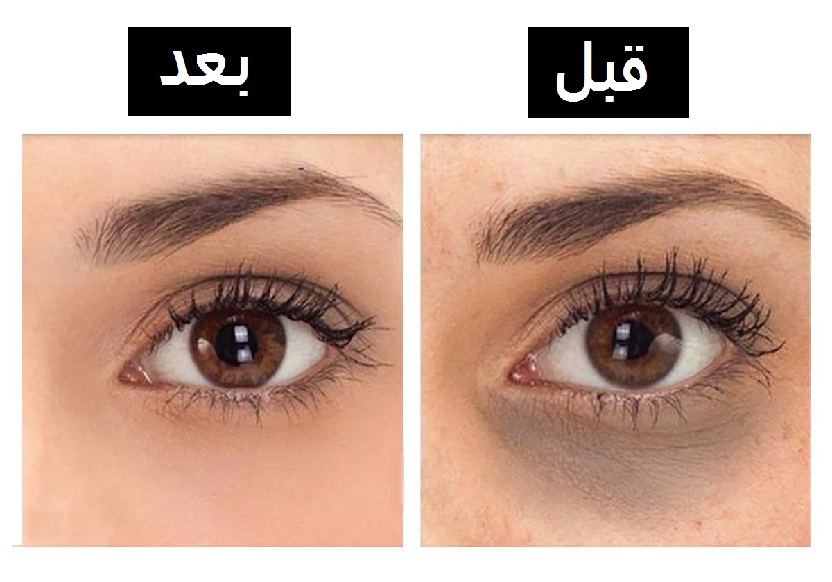 3 مكونات تخصلك من الهالات السوداء والجيوب خلال 15 دقيقة!