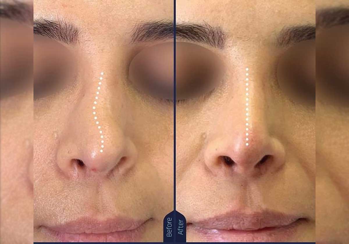 تقنية بديلة عن عملية تجميل الانف